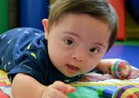 ¿Porque a bajado el número de bebés con síndrome de Down en Europa?