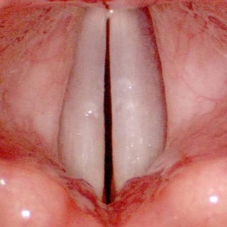 cuerdas vocales y polipos