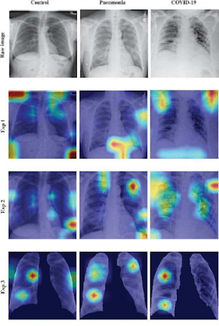 Inteligencia artificial para el diagnóstico de la COVID-19: análisis automático de radiografías simples de tórax