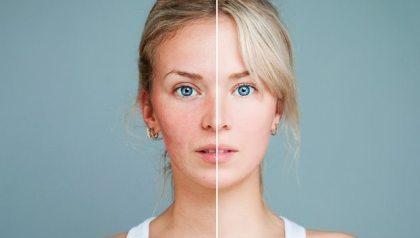 MASCARILLA CON MAICENA HECHA EN CASA-BLANQUEA-ACNE-ARRUGAS MASCARILLA CON MAICENA HECHA EN CASA-BLANQUEA-ACNE-ARRUGAS