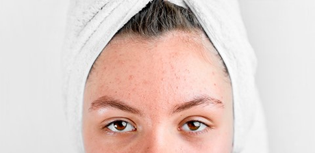 Acido Mandelico, exfoliante antibacteriano