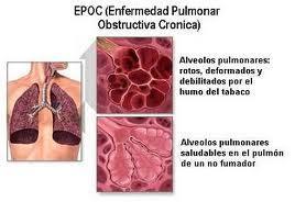 Enfermedad pulmonar obstructiva crónica (EPOC)