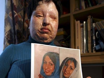 Una buena noticia.Mujer iraní cegada por ácido impid...