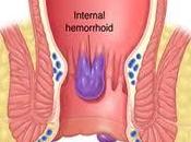 Hemorroides