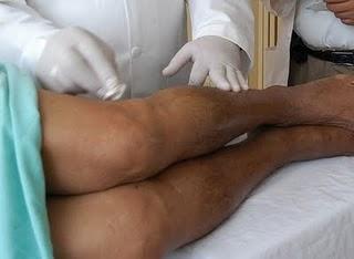 Evitar sedentarismo y sobrepeso, medidas eficaces para prevenir aparición de varices: IMSS