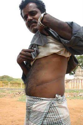 Tráfico de órganos