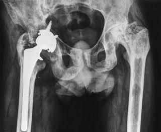 Nuevo tratamiento para la Enfermedad de Gaucher