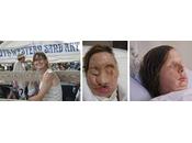 Recupera rostro gracias trasplante