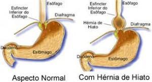 Hernia de hiato