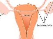 Endometriosis