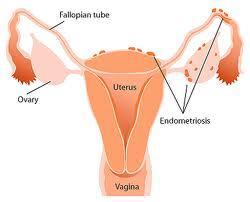 Endometriosis