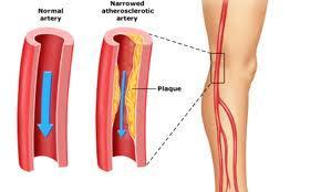 Claudicación intermitente