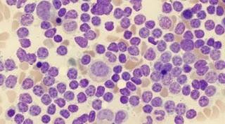 Científicos desarrollaron terapia genética para derrotar la leucemia