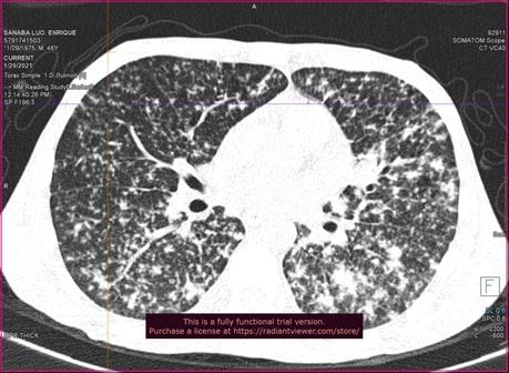 HALLAZGOS COMPATIBLES CON TUBERCULOSIS PULMONAR MILIAR.