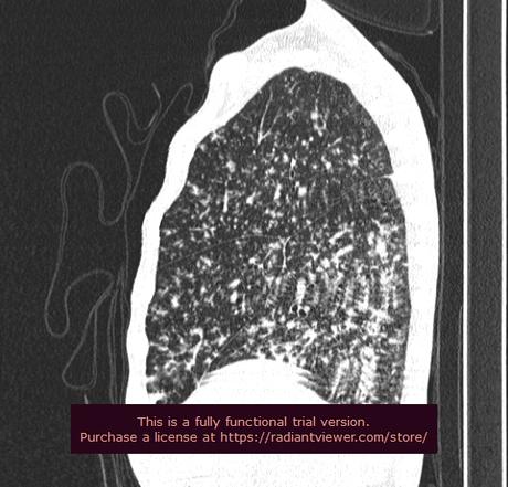 HALLAZGOS COMPATIBLES CON TUBERCULOSIS PULMONAR MILIAR.