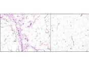 Desarrollan Test diagnóstico rápido preciso liposarcomas