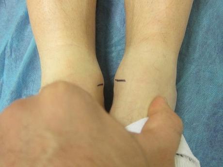 Dismetrías ¿afectan el rendimiento?