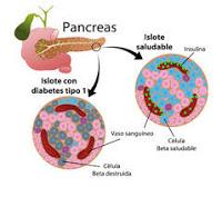 Un tratamiento experimental puede revertir la diabetes tipo 1