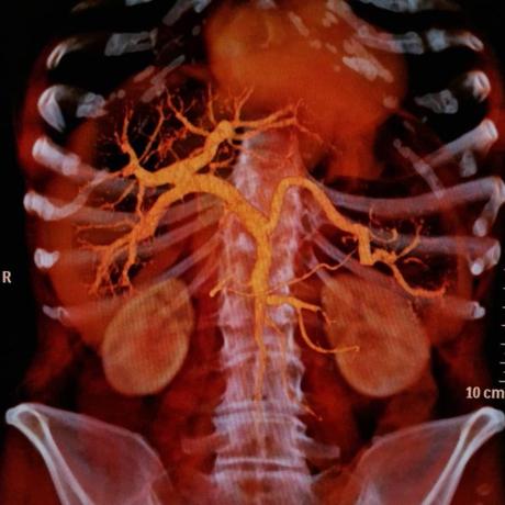 Circulación portal tac