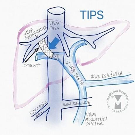 Circulación portal tac