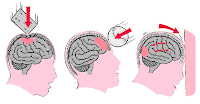 Efectos del Trauma a Nivel Celular y Tisular del Cerebro
