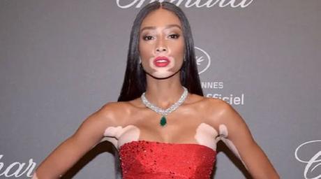 TODO LO QU NECESITAS SABER SOBRE EL VITILIGO