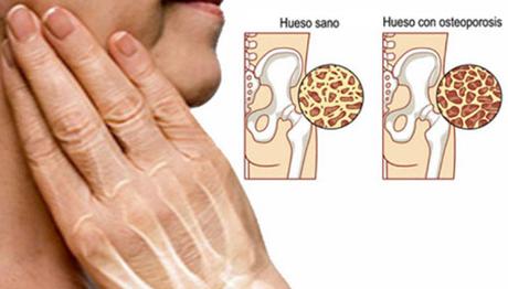 Osteoporosis: ¿Cómo vivir con ella?