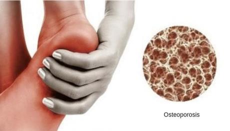 Osteoporosis: ¿Cómo vivir con ella?