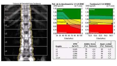 Osteoporosis: ¿Cómo vivir con ella?