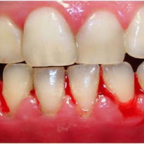 Mejores chicles de nicotina para dejar de fumar