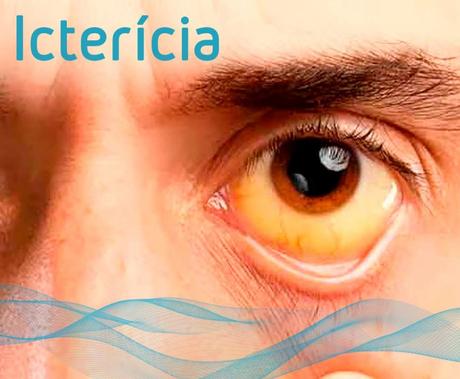 ¿Cómo se puede bajar la bilirrubina? bajar la bilirrubina