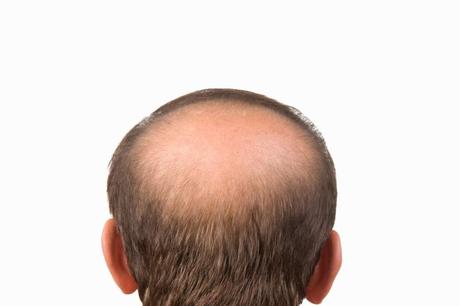 ¿Cómo prevenir alopecia androgenética? Natura Estilo