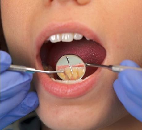 ¿Cuál es la mejor frecuencia para hacerse una higiene dental o limpieza bucal?