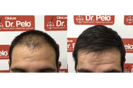 Señales de alopecia por Clínicas Dr. Pelo