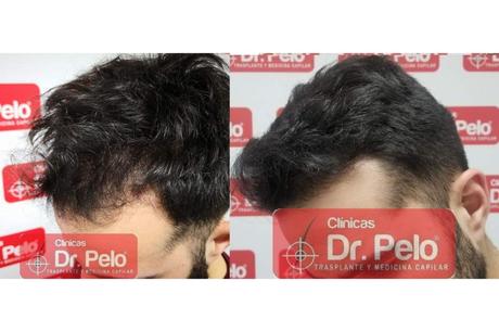 Trasplante capilar en Madrid: Clínicas Dr. Pelo