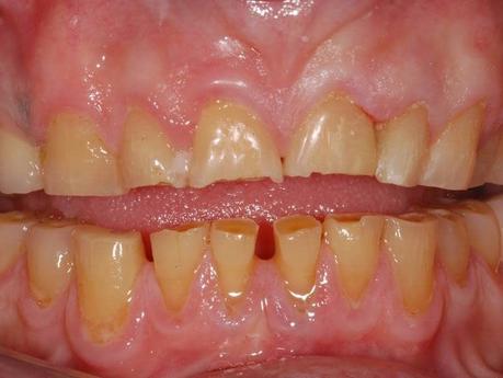 Consecuencias de no cepillarse los dientes
