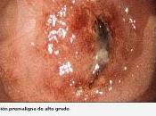 Aumentan casos Cáncer Cuello Uterino Venezuela