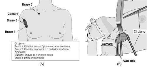 Tiroidectomía robóticamente asistida vs. endoscópica convencional