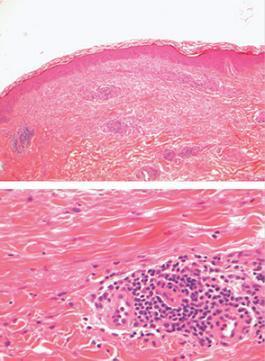 Dermatitis autoinmune por progesterona