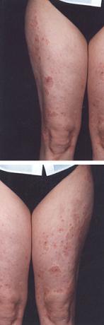 Dermatitis autoinmune por progesterona