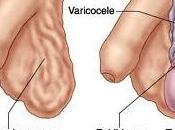 Varicocele
