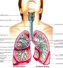 Asma Bronquial Asma Bronquial
