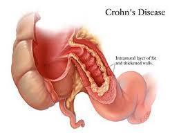 ¿Conoces la Enfermedad de Crohn?