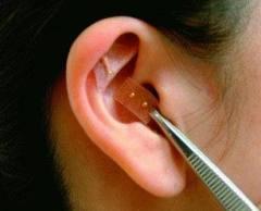 Para qué sirve la auriculoterapia