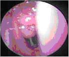 Esteroide Intranasal en Hipertrofia Adenoidea