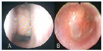 Esteroide Intranasal en Hipertrofia Adenoidea