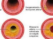 Infección aterosclerosis