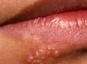 herpes para toda vida?