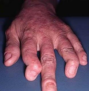 No más dolores y molestias en las articulaciones gracias a la biotecnología