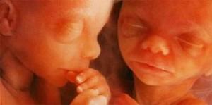 Qué es un embarazo gemelar, complicaciones y cuidados del embarazo gemelar